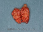 船橋　しこり　腫瘍　腫瘤　まぶた