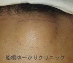 船橋　しこり　腫瘍　腫瘤　おでこ　脂肪