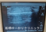 船橋　しこり　腫瘍　腫瘤　おでこ　脂肪