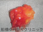 船橋　しこり　腫瘍　腫瘤　おでこ　脂肪