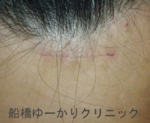 船橋　しこり　腫瘍　腫瘤　おでこ　脂肪