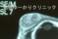 船橋　しこり　腫瘍　腫瘤　まぶた